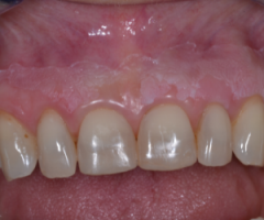 FAD ecm per Dentisti, Igienisti Dentali, Medico -dentista corso online Cancro-bocca 25 crediti ECM